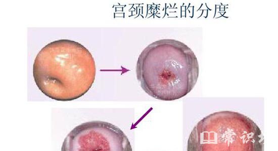 宫颈糜烂用什么药最好
